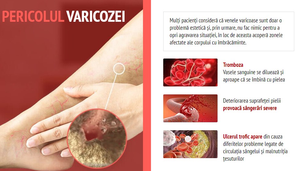 Рубрика: Tratarea varicelor în organele interne